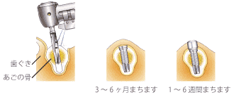 インプラントの流れ