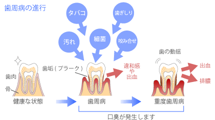 歯周病の進行